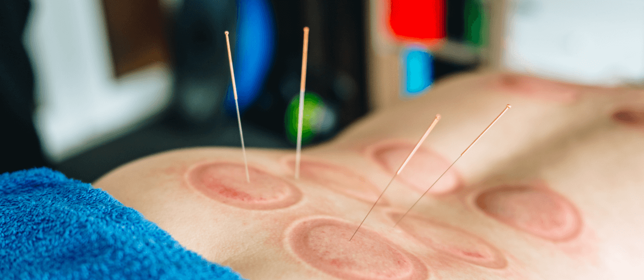 acupuncture lower back