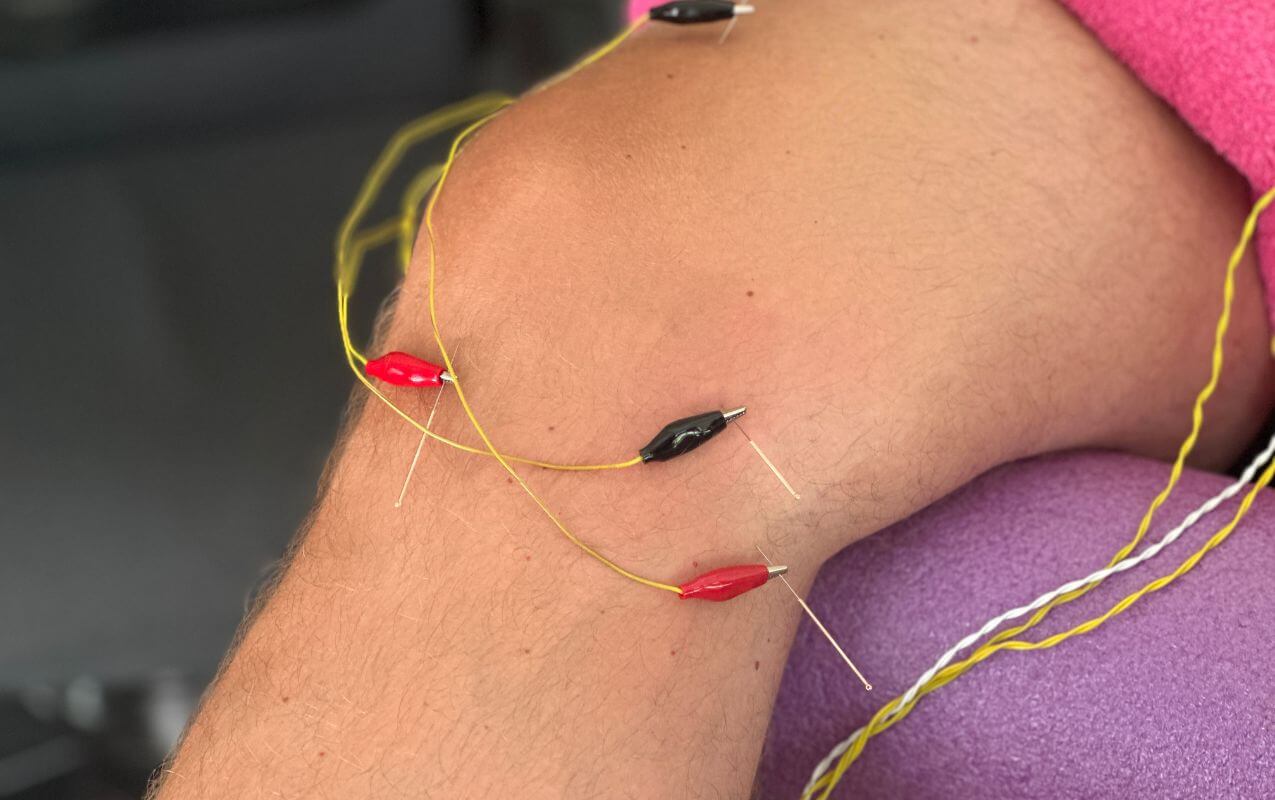 Electroacupuncture treatment on a person's knee with wires and needles attached