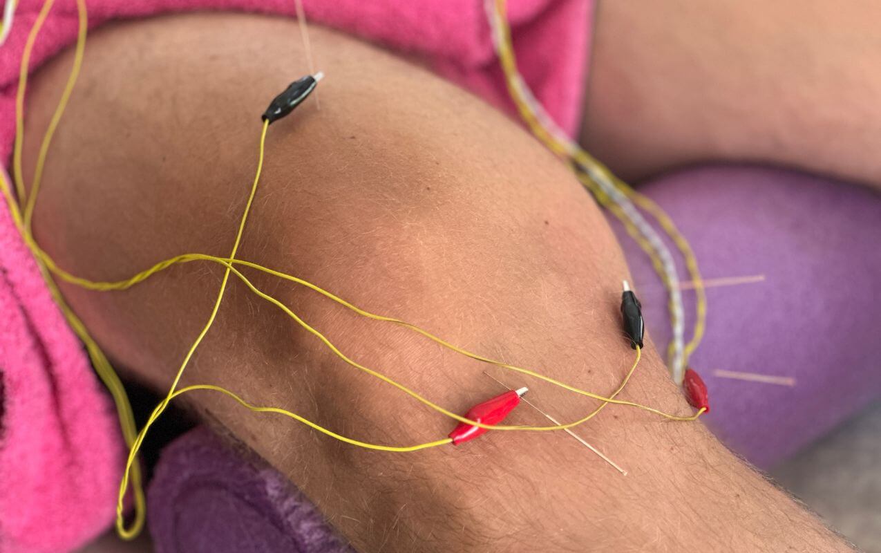 Close-up of a knee undergoing electroacupuncture therapy with electric leads and needles