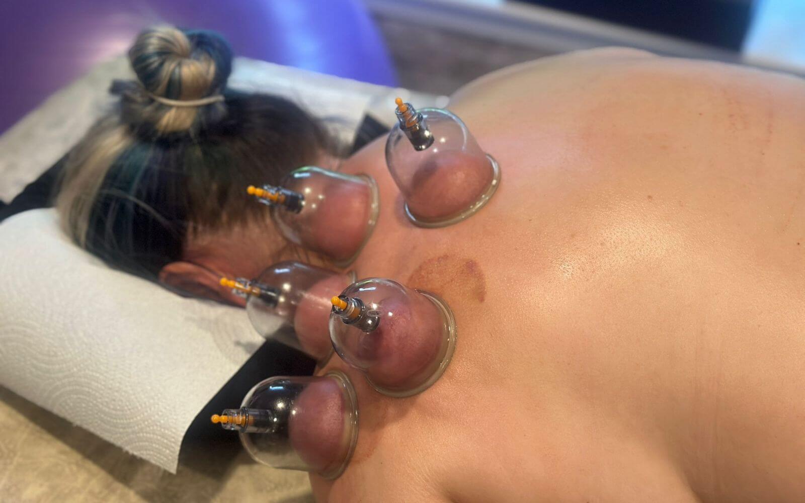 Close-up of cupping therapy being applied for neck pain relief in Glasgow