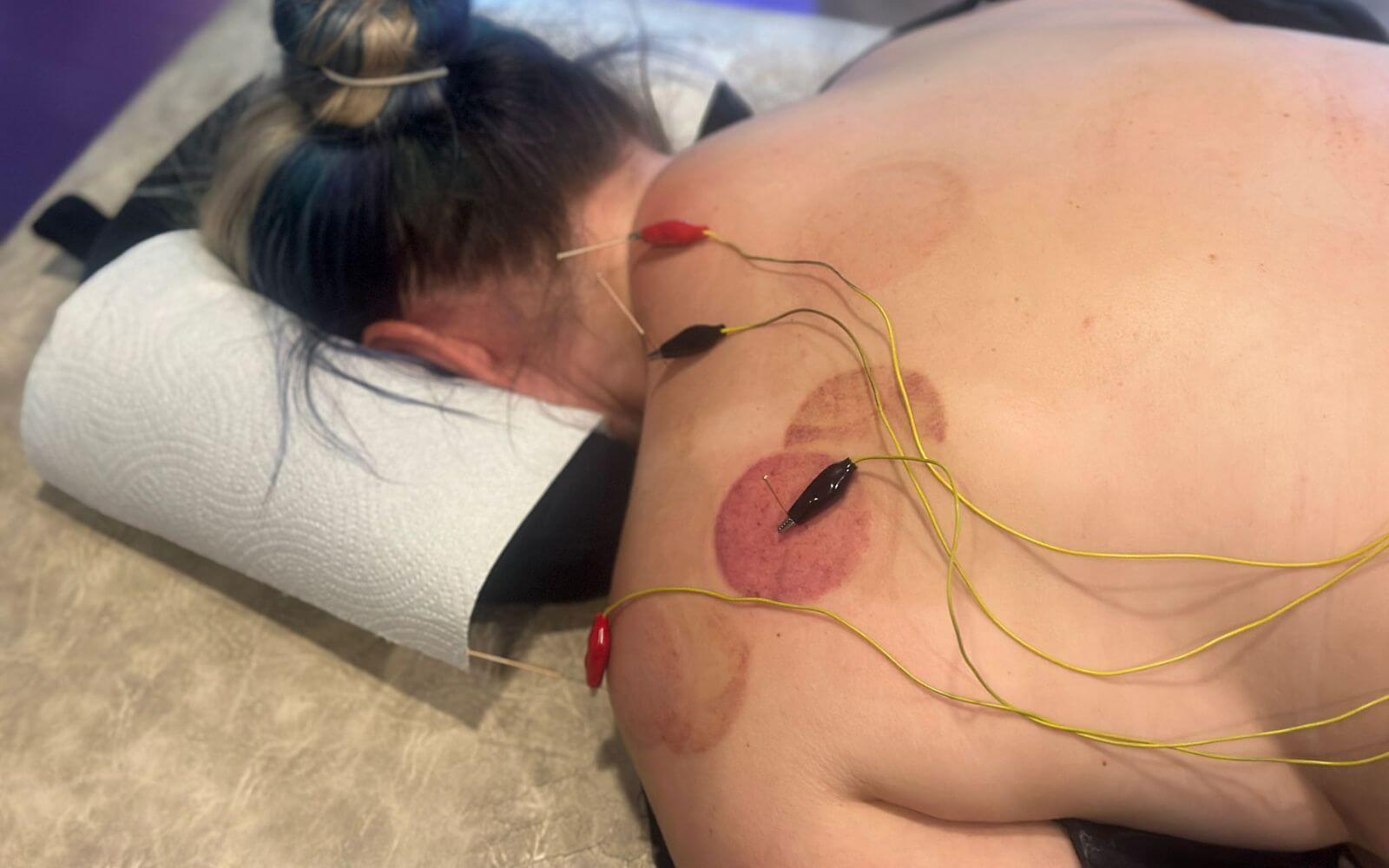 Electroacupuncture and cupping marks on a woman's upper back during neck pain treatment in Glasgow