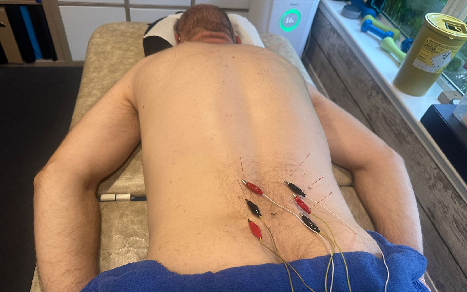 Man lying face down receiving electroacupuncture treatment on lower back in clinic setting.