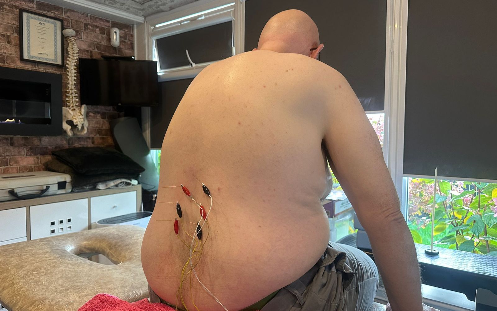 Man receiving electroacupuncture on lower back while seated in a physiotherapy clinic.