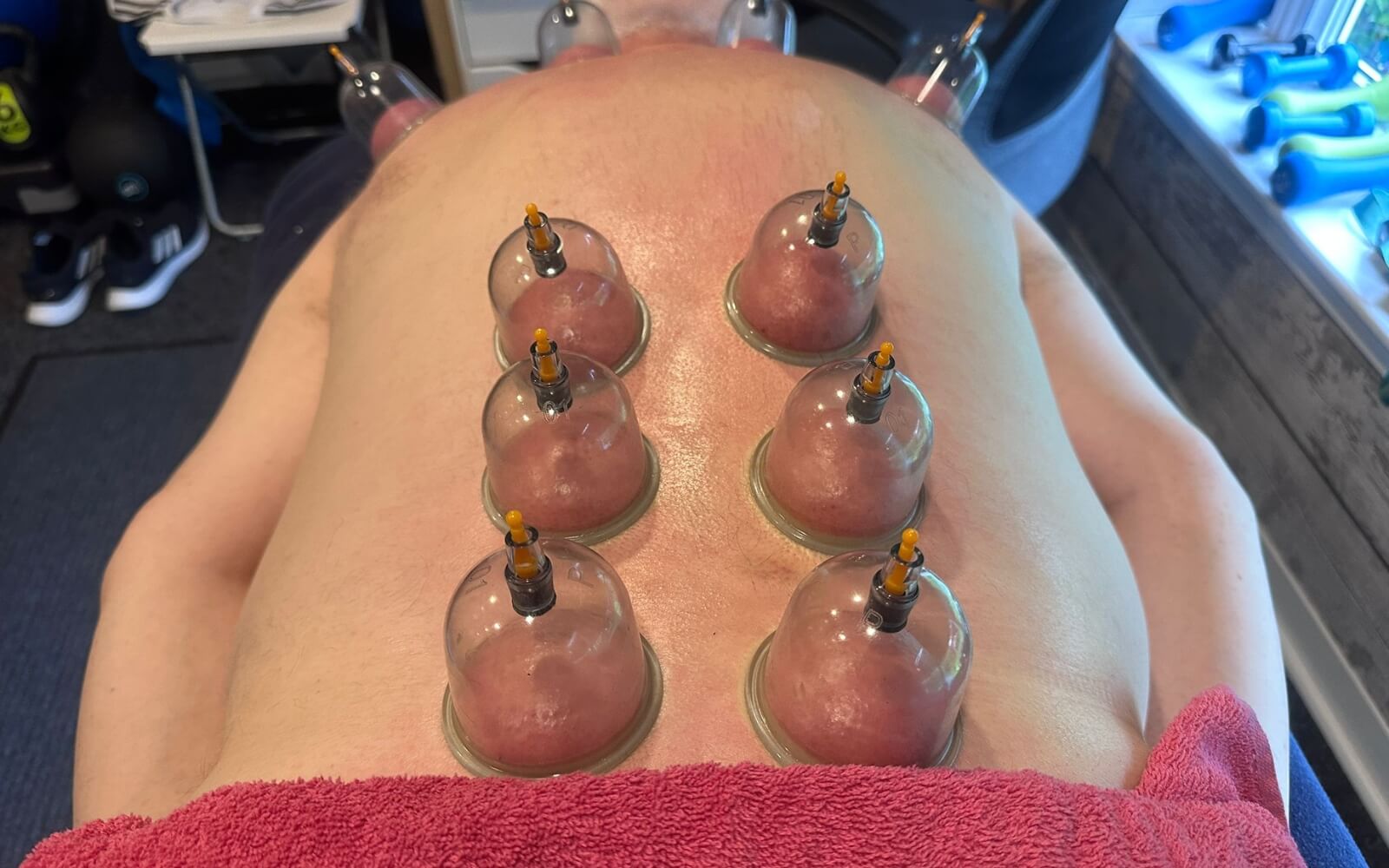 Multiple cupping cups placed along spine for back pain treatment in Glasgow