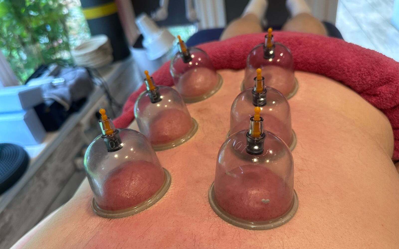 Cupping therapy cups on lower back during treatment at Peter's Physiotherapy Glasgow
