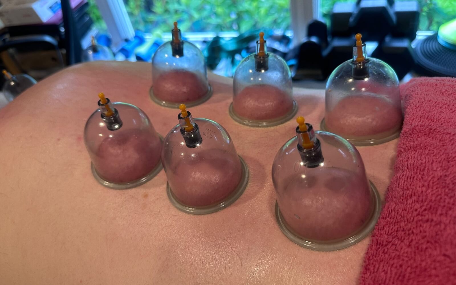 Cupping therapy session on upper back at Glasgow physiotherapy clinic